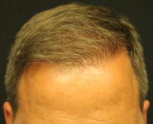 Neograft Hair transplantation