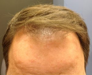 Neograft Hair transplantation