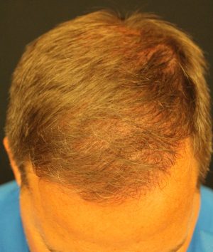 Neograft Hair transplantation