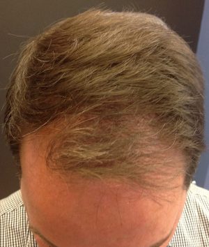 Neograft Hair transplantation