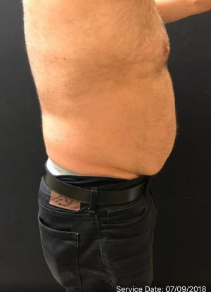 Smart Lipo