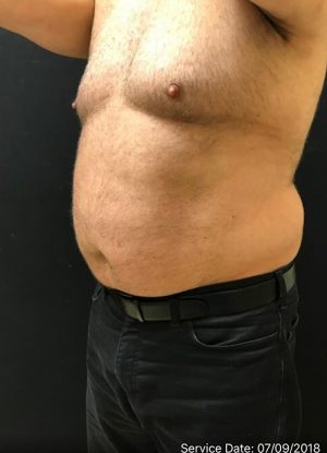 Smart Lipo