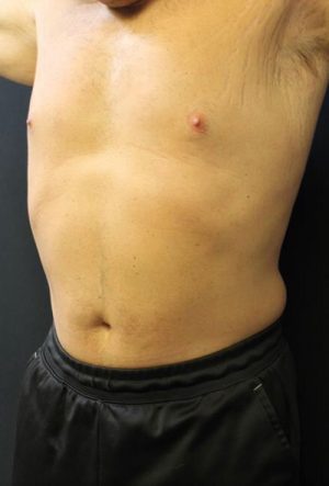 Smart Lipo