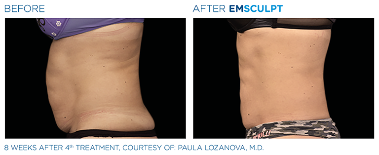 EMSCULPT Female Abdomen Profile