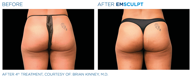 EMSCULPT Female Buttock