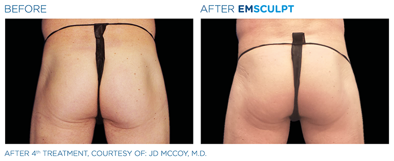 EMSCULPT Male Buttock Profile