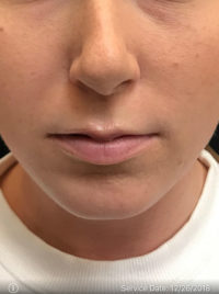 Lip Augmentation