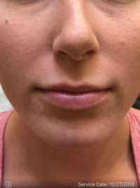 Lip Augmentation