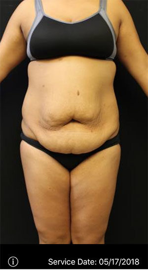 Tummy Tuck