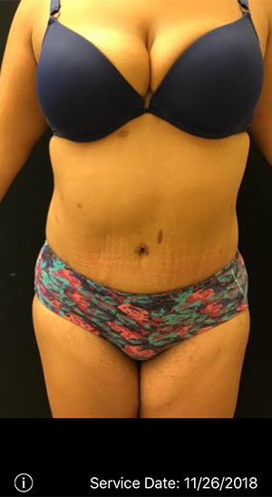 Tummy Tuck