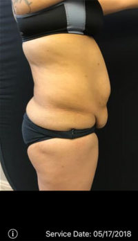 Tummy Tuck