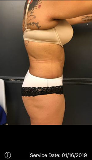 Tummy Tuck