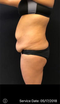 Tummy Tuck