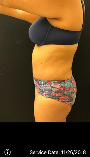 Tummy Tuck