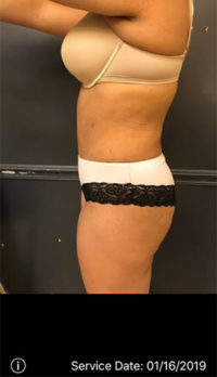 Tummy Tuck