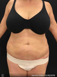 Liposuction