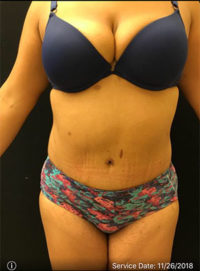 Liposuction