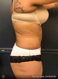 Liposuction