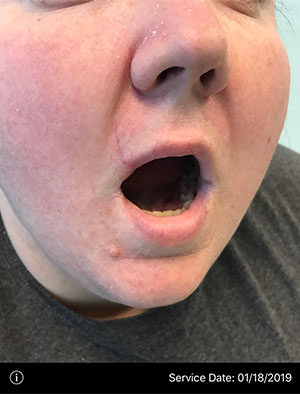 Facial Reconstruction