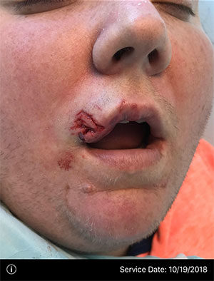 Facial Reconstruction