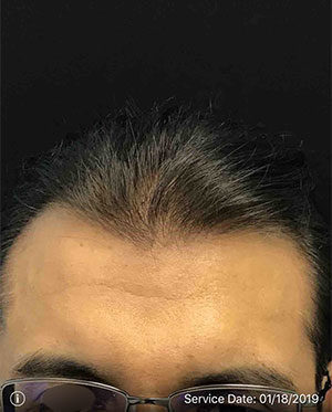 Neograft Hair transplantation