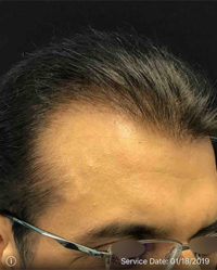 Neograft Hair transplantation