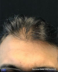 Neograft Hair transplantation