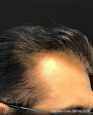 Neograft Hair transplantation