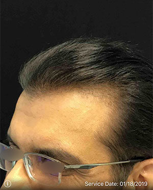 Neograft Hair transplantation