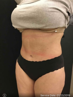 Tummy Tuck