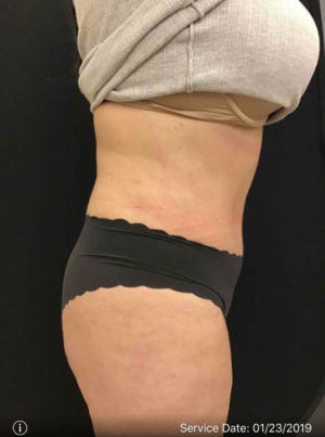 Tummy Tuck