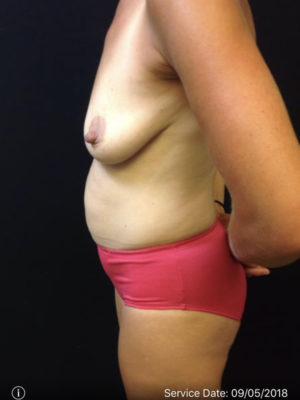 Tummy Tuck