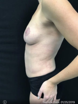 Tummy Tuck