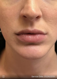 Lip Augmentation