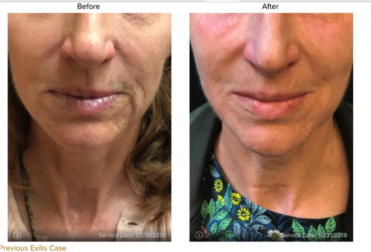 Nouveau Body II - Noninvasive Skin Tightening | Nouveau