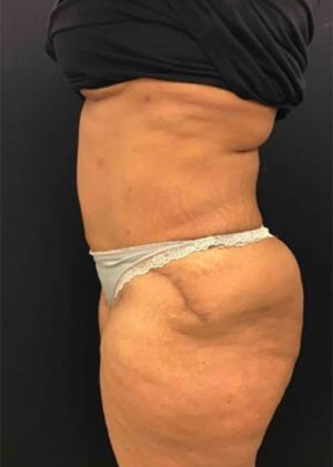 Tummy Tuck