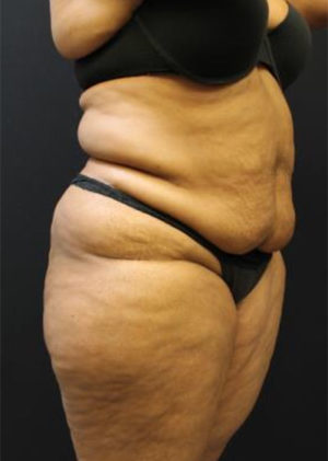 Tummy Tuck