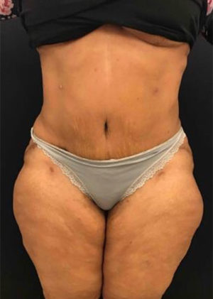 Tummy Tuck