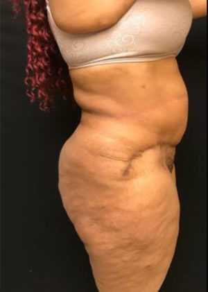 Tummy Tuck