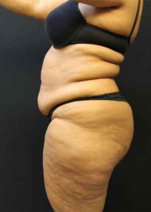 Tummy Tuck