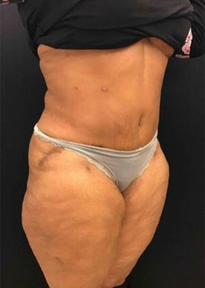 Tummy Tuck