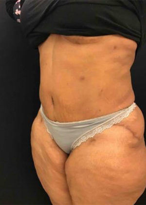 Tummy Tuck