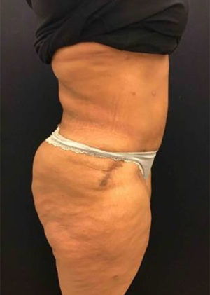 Tummy Tuck