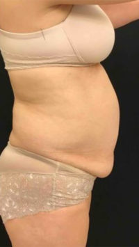 Liposuction