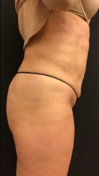 Liposuction