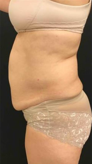 Liposuction