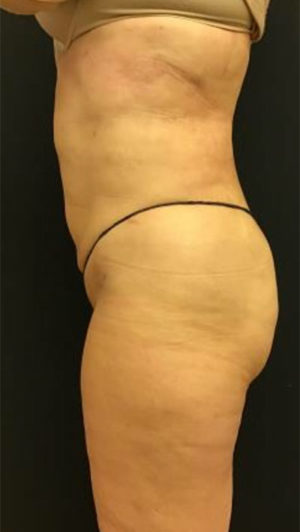 Liposuction