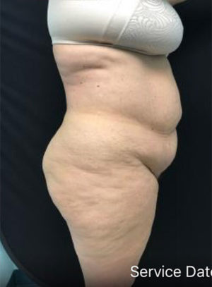 Tummy Tuck