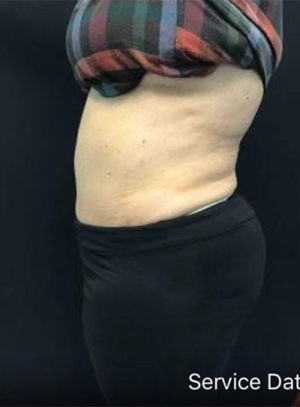 Tummy Tuck