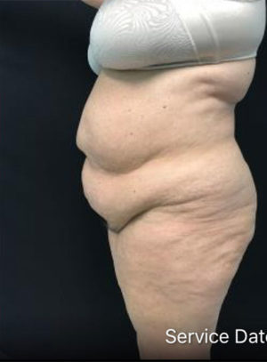 Tummy Tuck